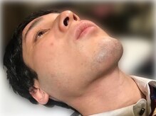 トーチ 船橋店(TORCH)/ヒゲ脱毛 [before]