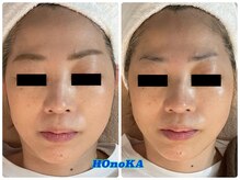 ホノカ(HOnoKA)/EMS