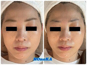 ホノカ(HOnoKA)/EMS