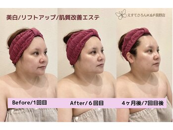 えすてさろん ケイアンドエフ(k&f)/【フェイシャル】極艶ハリアップ