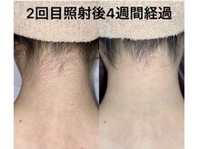 ブリランテ(Brillante)/気になるうなじ脱毛