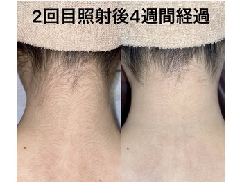 ブリランテ(Brillante)/気になるうなじ脱毛