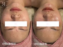 ポノ(Pono)/お肌のターンオーバーをサポート