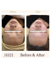 リバイセリー(Revicelly)/比較写真