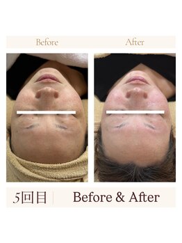 リバイセリー(Revicelly)/比較写真