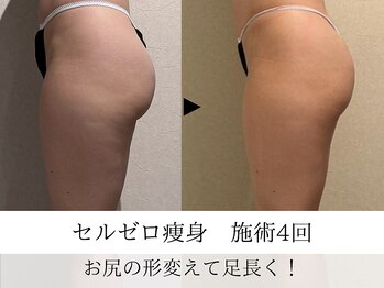 ウイ ネイルアンドビューティー(u'i nail&beauty)/大きいお尻の形を変えて足長効果