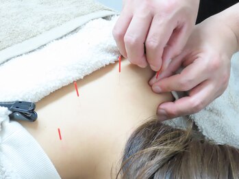 アルケル鍼灸整骨院/はり/肩こり/腰痛/筋肉の硬さ