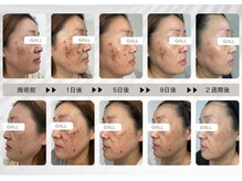 ジール(GIILL)/【シミケア】施術後の経過