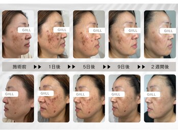 ジール(GIILL)/【シミケア】施術後の経過
