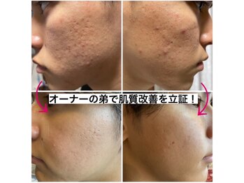 アンリミット(Unlimit)