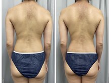 FJ/背中～腰の頑固な脂肪撃退◇痩身