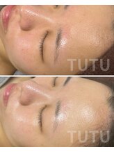 チュチュ(TUTU)/美白対策