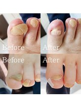 あしから/変形したネイルの処置