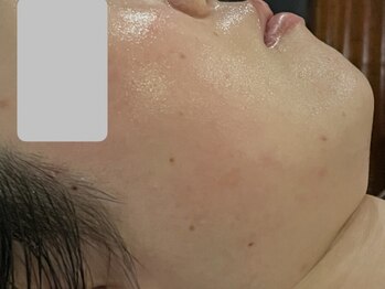 ハンディア(handear)の写真/ヒト幹細胞フェイシャルで自分史上最高の素肌に！お肌のバランスが崩れていて、なかなか効果の出ない方に◎