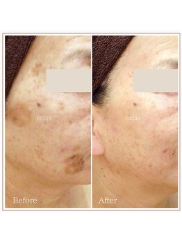 ベルタ(BELTA)/ケア前→7ヶ月後　シミ