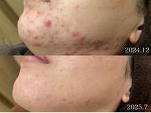 エピア 三河安城店(Epia)の雰囲気(繰り返すニキビケアもお任せ下さい♪)