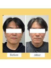 クローバー(clover)/【before/after】施術１回目翌日