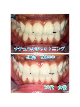 プラチナムビューティー 川口駅前店(PLATINUM BEAUTY)/ハイパーモデルの照射機◎