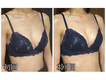 リルマコ/バスト症例写真