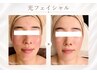 【人気No1】リフトアップ光フェイシャル(ヘッドマッサージ付き)¥10000→¥4000