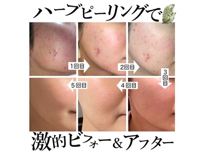 ハーブピーリング専門店 HERB garage 福岡天神店【肌質改善】【8/1 OPEN（予定）】の写真
