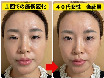 凛と慶/40代女性の施術変化