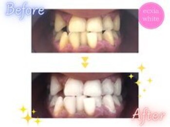 エクシアホワイトニング 高崎店/ビフォーアフター
