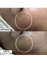 ミナミ(MINAMI)/モヤモヤとしたしみのケア