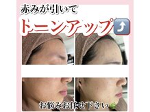 ホワイトアクア 姫路店(WHITE AQUA)/ハーブピーリング/姫路/美肌