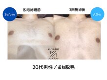 メンズアメリ/高知/メンズ脱毛/ヒゲ/全身/VIO