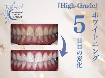 ラフ(LAUGH)/【審・美・白】 ホワイトニング