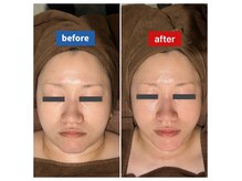 肌質改善＆小顔効果のあるエステはお任せ下さい