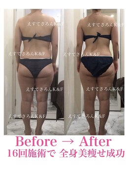 えすてさろん ケイアンドエフ(k&f)/ 施術結果16回