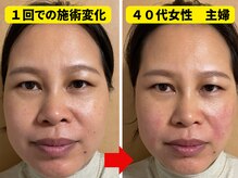 凛と慶/4０代女性の施術変化