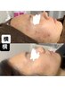 【人気no１◎】頑固ニキビケアに剥離有フェイシャルハーブピーリング ¥15000