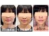 【どのクーポンにしようか迷われた方へ】おまかせ小顔矯正