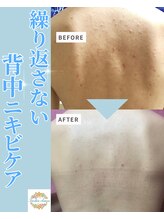 ラウレア オハナ(Laulea ohana) 背中 ニキビケア