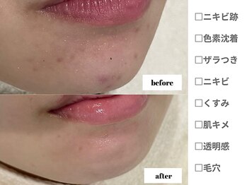 アンシャンテ 神戸元町店(Enchante)/毛穴洗浄ピーリングフェイシャル