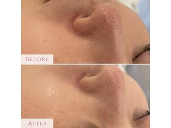 ミエル 神戸店(Miel)/毛穴洗浄で黒ずみ改善