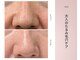 リアン(Lien)の写真/毛穴の目立ち・小じわ・くすみ・肌のハリ低下に◎AHAピーリング&レチノールで、内側から弾む むき卵肌へ!