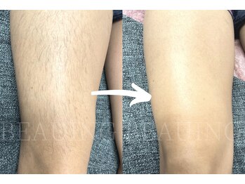 ビューイング(美ing)/効果抜群!!うで脱毛♪