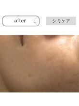 アイチューズ(ICHOOSE)/たった2ヶ月の集中ケア♪