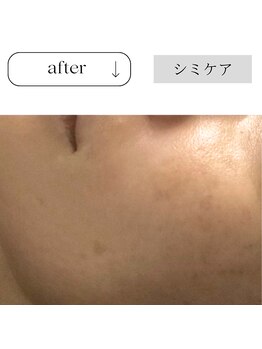 アイチューズ(ICHOOSE)/たった2ヶ月の集中ケア♪