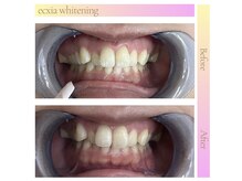 エクシアホワイトニング 仙台駅東口店/ホワイトニングビフォーアフター