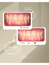 スリール(sourire)/ビフォーアフター