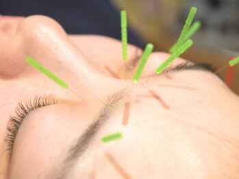 あたまの再起動の写真/《ズーンと重たい眼精疲労を鍼×電気でスッキリ改善》パッと明るくクリアな視界で頭痛も解消◎