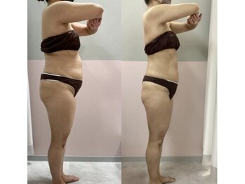 ローズハニー 小田原店/痩身モニター様比較写真