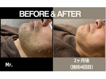 ミスター(Mr.)/【光脱毛】