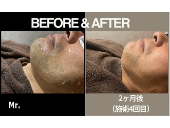 ミスター(Mr.)/【光脱毛】