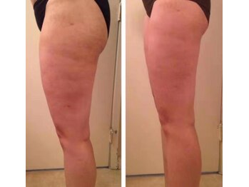 クライオ360(Cryo360)/脂肪冷却ビフォーアフター